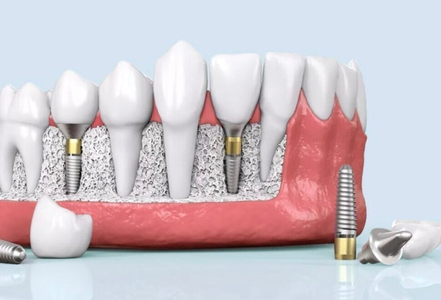 ایمپلنت-دندان-در-مرزداران
