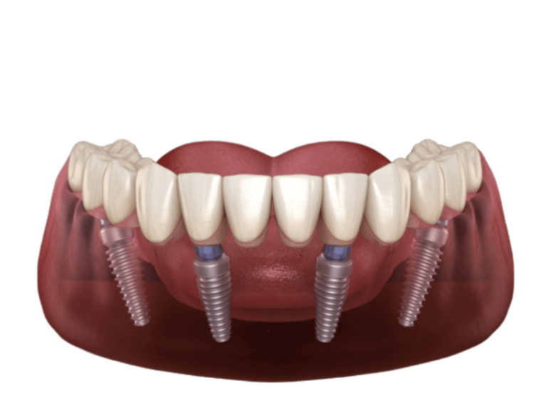 ایمپلنت-All-on-4