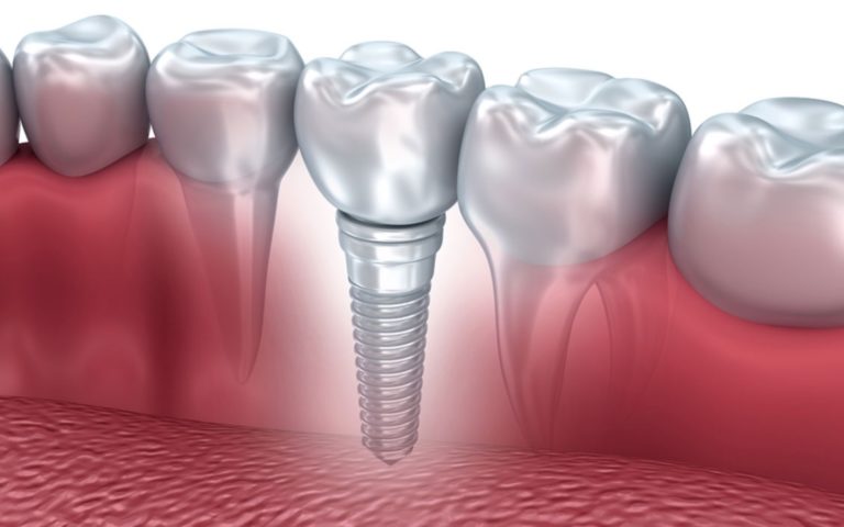 تفاوت-دندان-مصنوعی-و-ایمپلنت