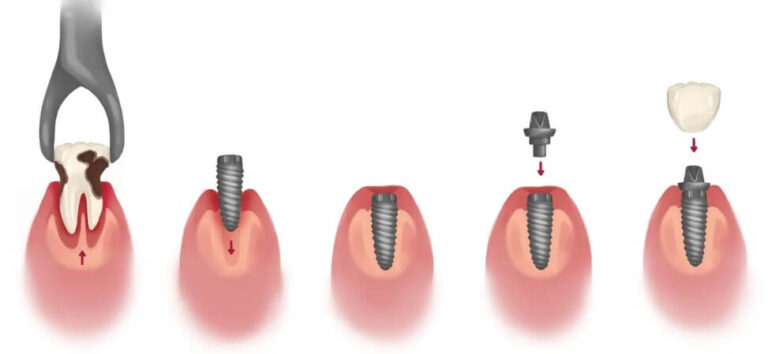 مراحل-ایمپلنت-پس-از-کشیدن-دندان